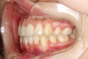 前歯の前突も改善しています。